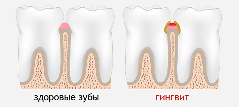 Лечение гингивита