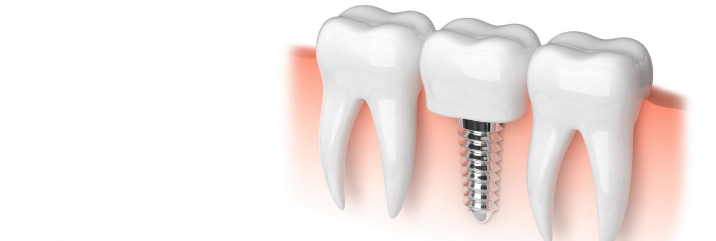 Имплантация зубов