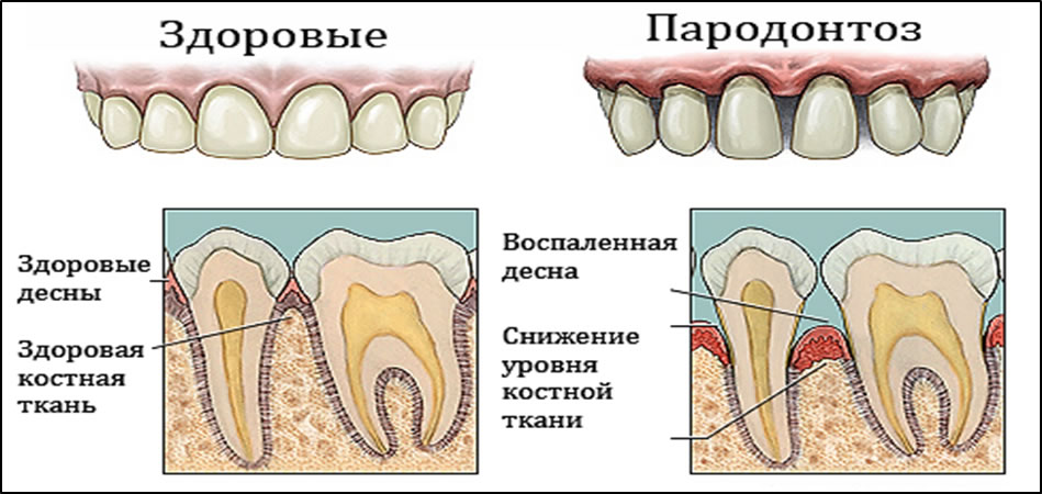 Лечение пародонтоза