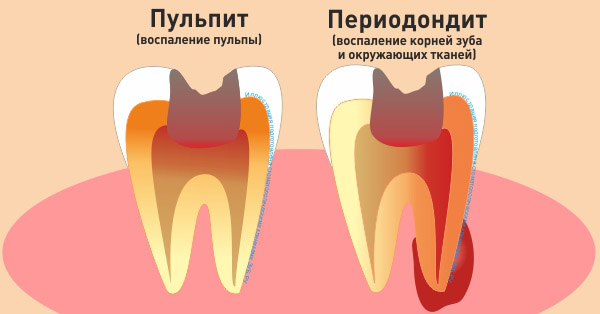 Лечение пульпита молочного зуба